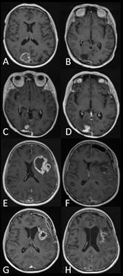 Frontiers | High-Grade Glioma Treatment Response Monitoring Biomarkers ...